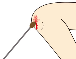 軽い傷ややけどの消毒