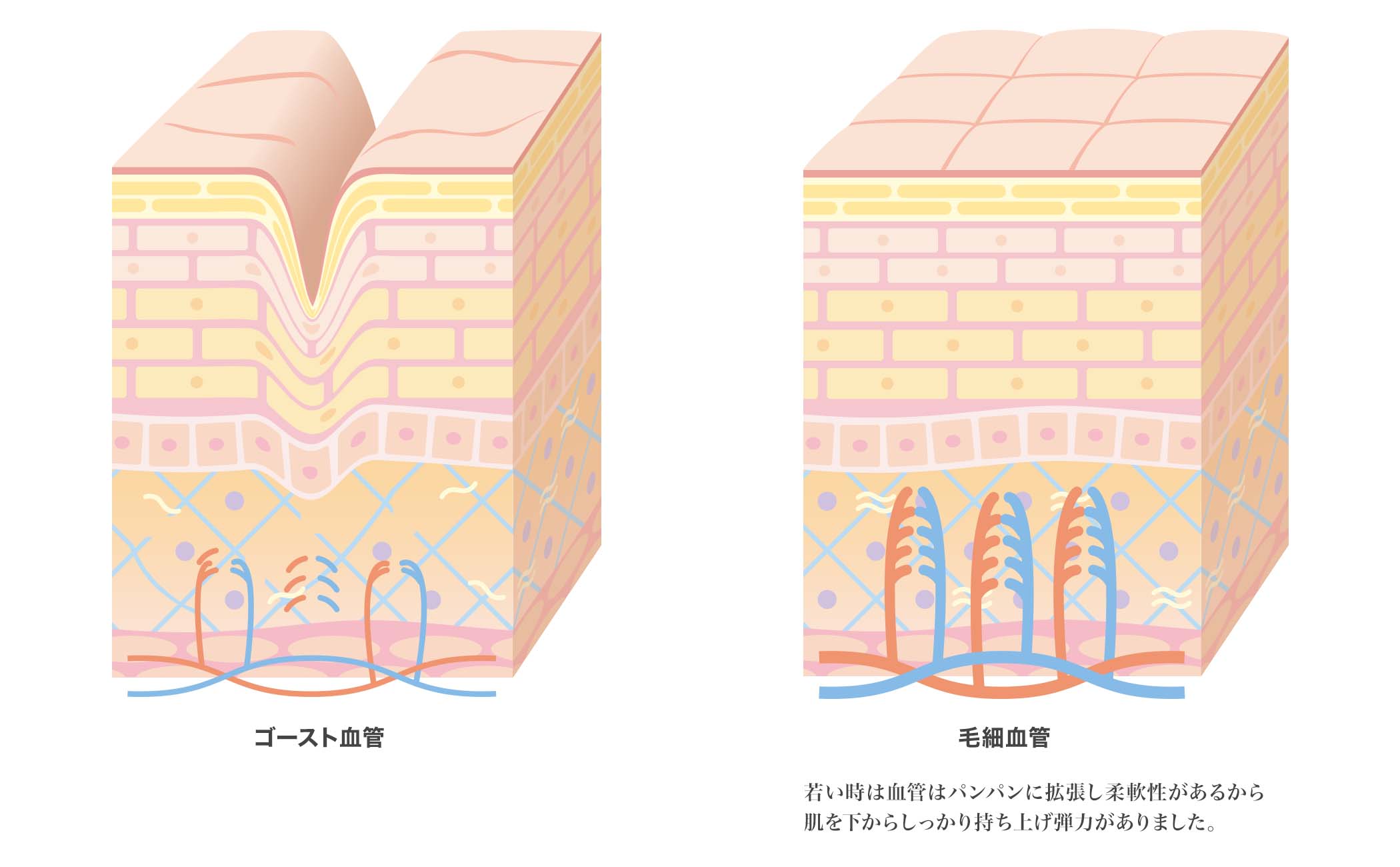 加齢と共に進む動脈硬化血管は細くなり、張りが無くなる